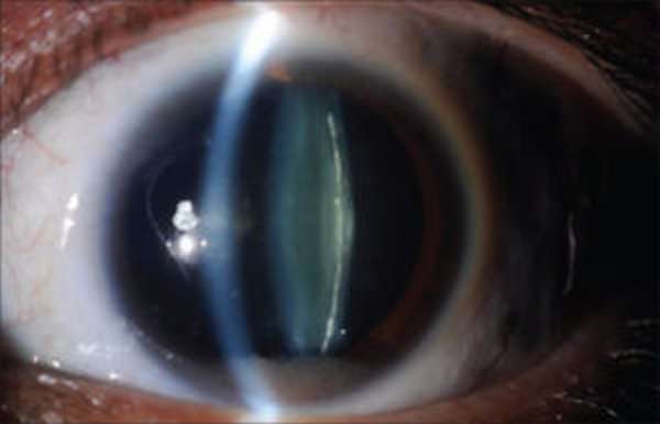 Заднекапсулярная катаракта: что это такое, симптомы и лечение